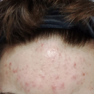 Swatch de dodo72 : Soin Intense Anti-Imperfections ACT-5, Nubiance Dermocosmétique