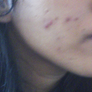 Swatch de Crystal87 : Soin Intense Anti-Imperfections ACT-5, Nubiance Dermocosmétique