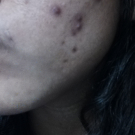 Swatch de Crystal87 : Soin Intense Anti-Imperfections ACT-5, Nubiance Dermocosmétique