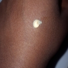 Swatch de Tamilachi : Triacnéal Soin, Avène